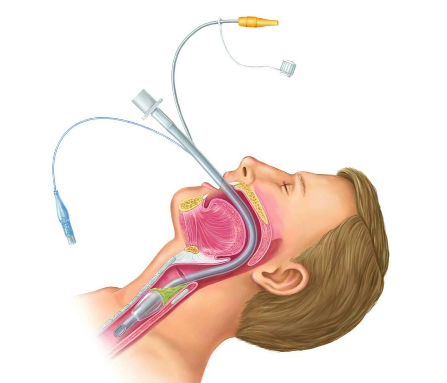 Трубка через рот. Интубационная трубка ИВЛ. Интубационная анестезия. Интубация эндотрахеальной трубки.